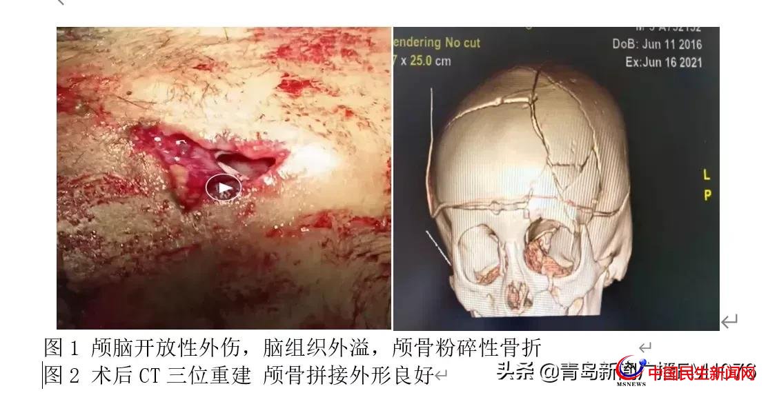 5歲男童6樓墜落命懸一線，婦兒醫(yī)院多學(xué)科協(xié)作再勝“死神”